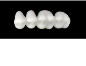 Cod.EXUPPER LEFT : 15x  posterior hollow wax veneers-bridges, X-LARGE, (24-27), with precarved occlusion to Cod.EXLOWER LEFT, and compatible to Cod.SXUPPER LEFT (solid), (24-27)